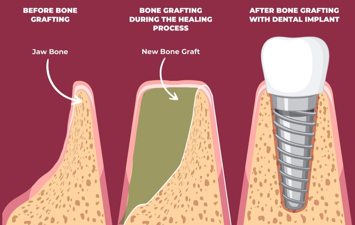 Diagram showing bone grafting before dental implant placement: before grafting, during healing, and after grafting with the implant placed